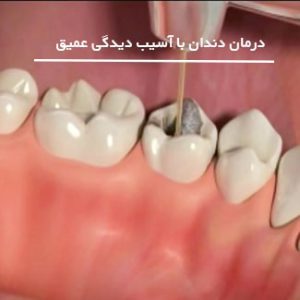 درمان دندان به عصب رسیده