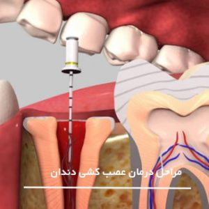 چند مرحله ی عصب کشی دندان
