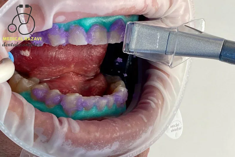 سفید کردن دندان به روش بلیچنگ در کلینیک