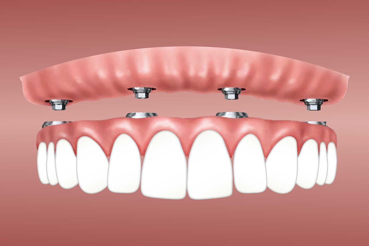 ایمپلنت دندان چیست؟