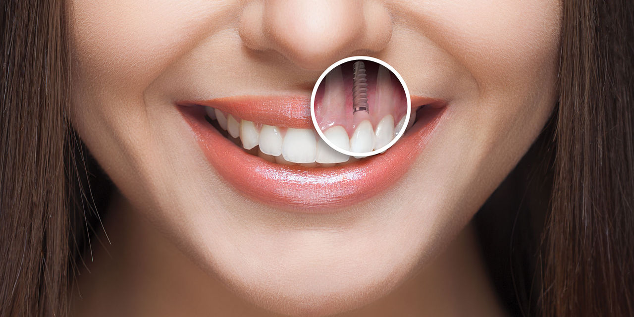 ایمپلنت دندان چقدر زمان نیاز دارد؟